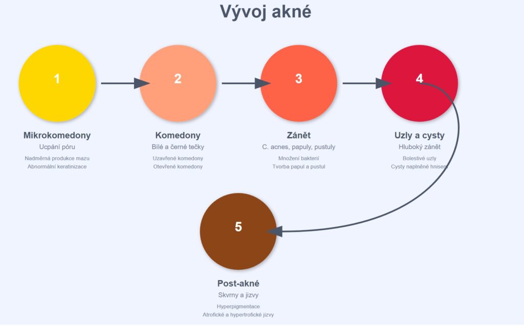 Mechanismus vzniku akné